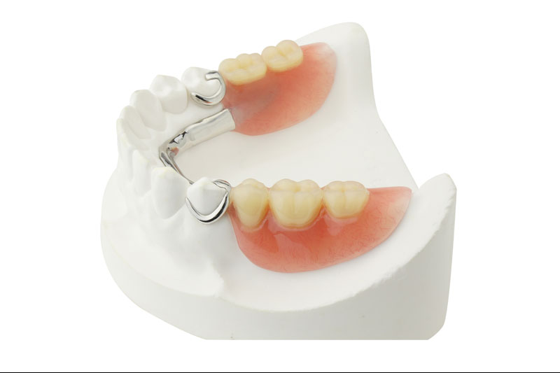 Partical-dentures