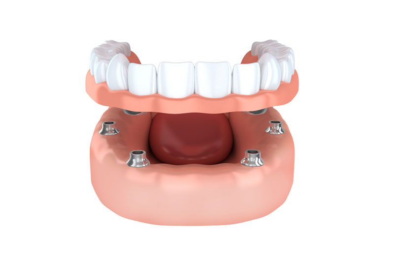 implant-dentures